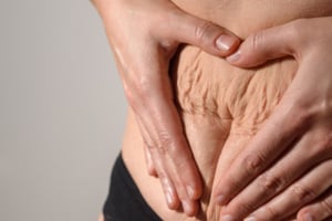 Update Rektusdiastase